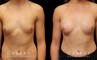 Patient wanted very mild breast augmentation to improve the roundness and curve of breasts. Results show increase from minimal breast shape to a gentle rounding slope to the breasts.