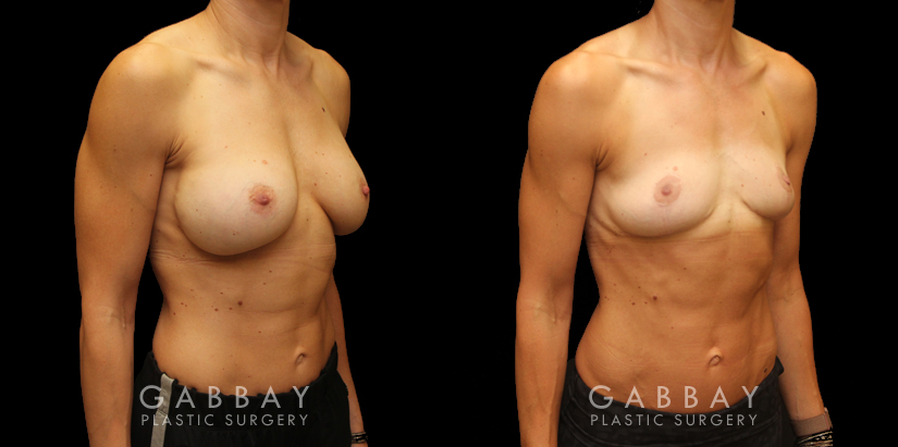 Procedures Depicted:  Implant removal/Mastopexy/Auto Augmentation