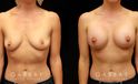 Procedures Depicted:  Breast augmentation with areola lift