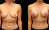 Procedures Depicted:  Breast augmentation with areola lift