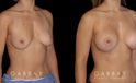 Silicone breast implants results. Note how the breast slope was retained in profile while still achieving a notable bust silhouette.
