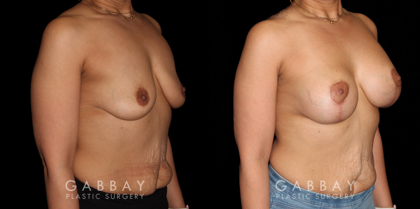 Procedures Depicted:  Breast Augmentation – Silicone & Lift