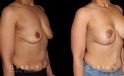 Procedures Depicted:  Breast Augmentation – Silicone & Lift
