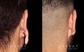 Patient 01 Back View Earlobe Repair Gabbay Plastic Surgery