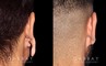 Patient 01 Back View Earlobe Repair Gabbay Plastic Surgery