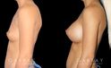 Before-and-after photos for breast augmentation with saline implants. The choice of saline implants allowed for more dramatic increase in breast size while having no visible scars.