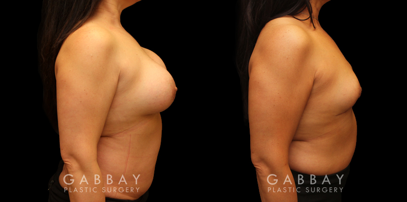 Procedures Depicted:  Auto Augmentation with lift