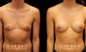 This is an extremely athletic woman who wanted a softer look for her torso. She had silicone breast augmentation using Allergan Natrelle soft touch moderate profile implants placed through a lower breast/inframammary incision and under her muscle in a dual plane position.. Her implants were 255 cc.