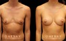 This is an extremely athletic woman who wanted a softer look for her torso. She had silicone breast augmentation using Allergan Natrelle soft touch moderate profile implants placed through a lower breast/inframammary incision and under her muscle in a dual plane position.. Her implants were 255 cc.