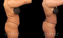Female patient with 360 liposuction and skin tightening with fat transfer to buttocks, creating a slimmer appearance with a well-rounded butt.