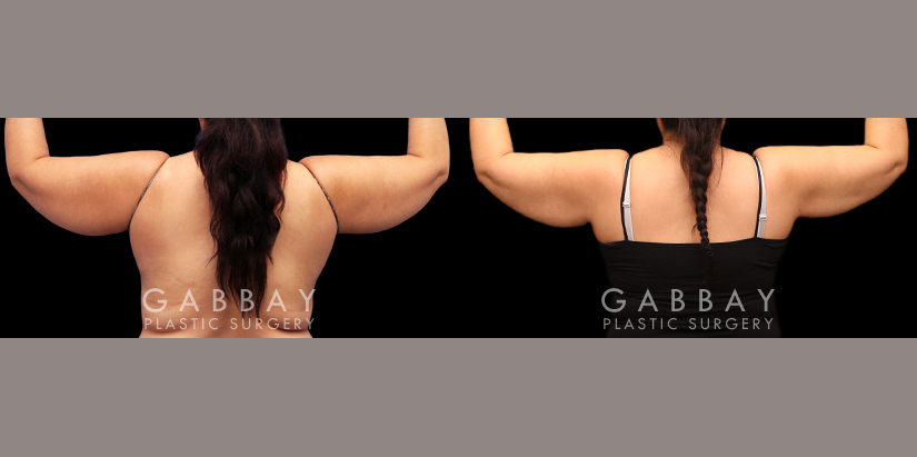 Procedures Depicted:  Lipo arms