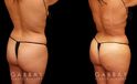 Back and side view of female patient results before and after liposuction to abdomen and waist with fat transfer to butt. Lipo results provided abdominal and waist contouring, slimming the figure while providing increased volume and shape to the buttocks. All volume increase is from injections with no artificial implants used. Note natural appearance and lack of visible scarring.