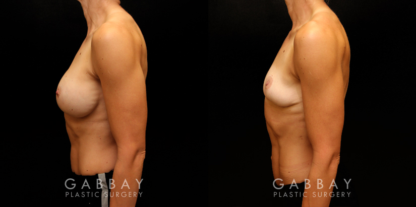 Procedures Depicted:  Implant removal/Mastopexy/Auto Augmentation