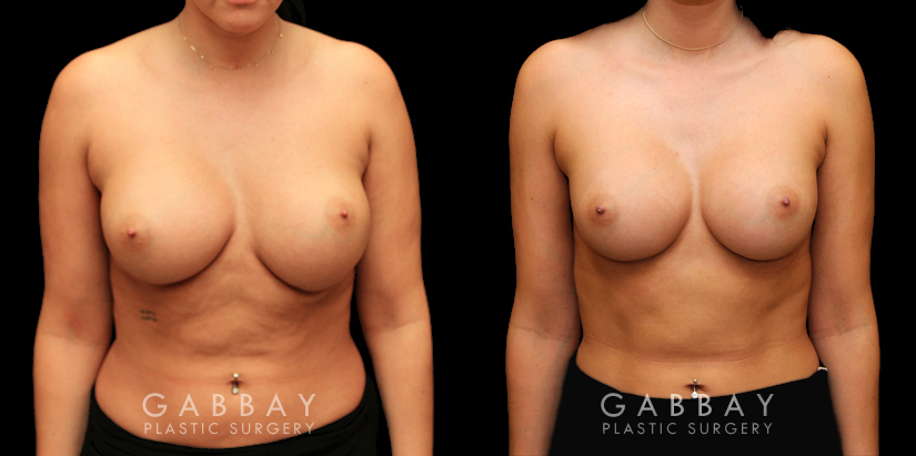 Procedures Depicted:  Replacement and Removal one side mesh