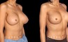 Patient 07 3/4th Right Side View Breast Revision Gabbay Plastic Surgery