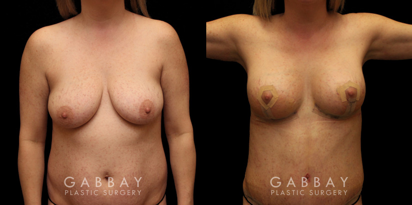 Procedures Depicted:  Breast aug/pexy and tummy tuck