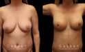 Procedures Depicted:  Breast aug/pexy and tummy tuck