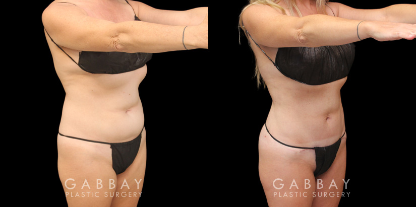 Patient 03 Front View Mini Tummy Tuck Gabbay Plastic Surgery