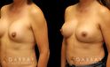 Patient before-and-after photos for implant removal and replacement procedure. This revision breast augmentation went well and patient was satisfied with how her new implants looked and felt.