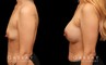 Breast augmentation results after complete recovery. Careful placement of silicone implants resulted in natural breast appearance and position.