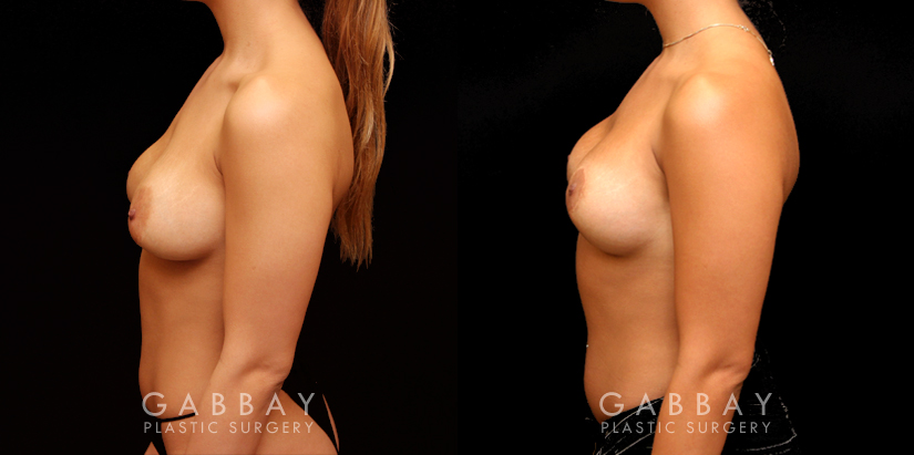 Procedures Depicted:  Removal and Replacement of SIL Implants; capsulorrhaphy