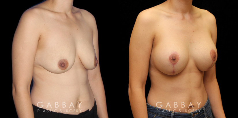 Procedures Depicted:  Augpexy