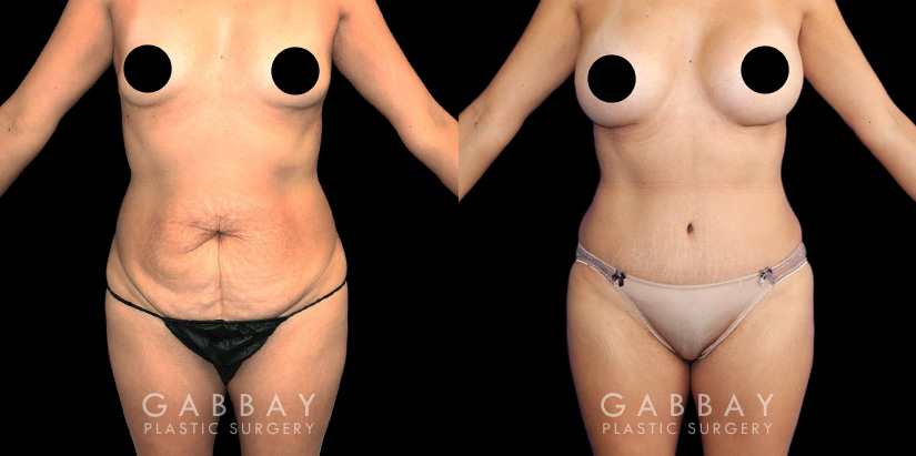 Mommy Makeover Beverly Hills Before and After by Dr. Gabbay