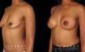 Before-and-after photos for saline implant breast augmentation patient. Her implant choice allowed for more natural shape and slope to the breasts, most notable in the profile view.