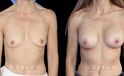 Female patient in her late 40s with breast augmentation results using silicone implants. Patient healed well and achieved a breast size and appearance that enhances a youthful contour and appearance.