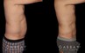 Male patients with liposuction results for full abdominal contouring. Patient healed well with minimal visible scarring and a flat stomach as seen in the profile view.
