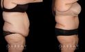 Abdominoplasty patient results, highlighting the loose skin and folds before the procedure. Following surgery, the patient recovered without complications and saw lasting tummy tuck results with a flatter profile.
