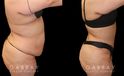 Mommy makeover before-and-after photos depicting results of combined 360 liposuction and tummy tuck. Note particularly how flank liposuction and tightening resulting in restoring a curvier silhouette and a natural-looking figure. Both the abdomen and flanks were tightened and smoothed for a youthful contour from every angle.