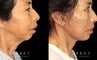 Patient 02 Right Side View Chin Implant, facelift, Bleph Gabbay Plastic Surgery