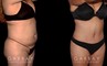 Female patient before and after abdominal liposuction with significant flattening of the stomach area for a refined profile. Patient healed quickly with no complications and maintained her results easily.