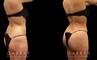 BBL surgery results for female patient after the fat injections fully settled. Note the significant increase in buttocks volume without the use of butt implants, resulting in a rounded, lifted shape that curves into the small of the back for an enhanced contour. Around the waist, back, and abdomen, 360 liposuction provided a smooth slimming effect that emphasizes the full roundness of the butt.