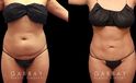 Abdominoplasty before and after photos post-recovery. Patient’s healing went smoothly, resulting in a firmer, tighter abdominal region, with a refined contour particularly visible in side profile.