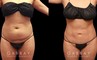 Abdominoplasty before and after photos post-recovery. Patient’s healing went smoothly, resulting in a firmer, tighter abdominal region, with a refined contour particularly visible in side profile.