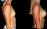 Patient results following complete recovery from breast augmentation procedure. Patient achieved increased bust size with a refined proportion to her slimmer torso and waist.
