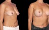 Procedures Depicted:  Wise Mastopexy with Silicone Breast Implants