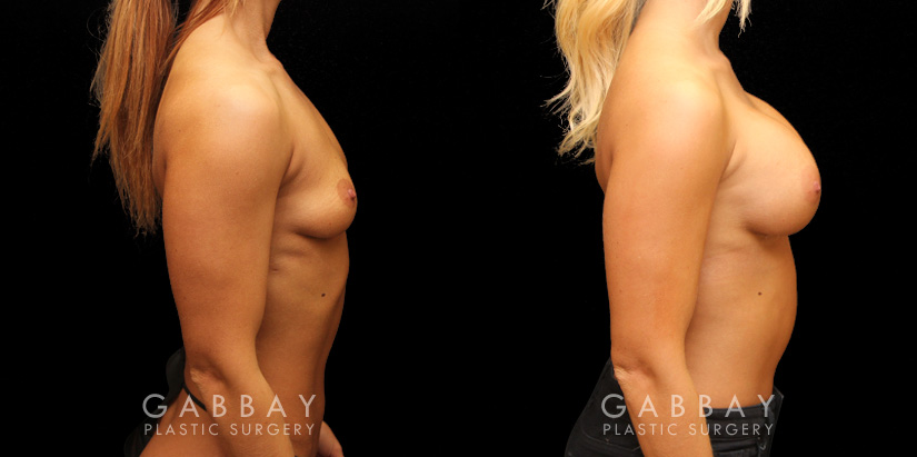 Procedures Depicted:  Implants repeal & replacement (left)