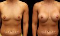 Patient photos showing before and after her breast augmentation procedure, with notable breast size increase while maintaining a balanced aesthetic.