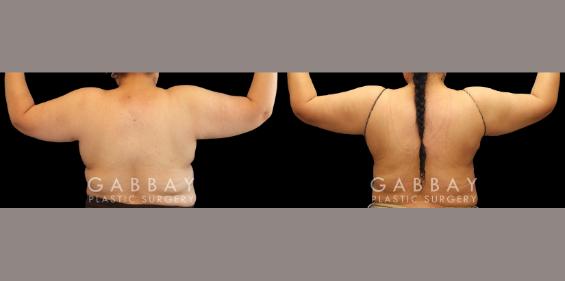 Procedures Depicted:  Liposuction BBR and Arms with J-Plasma