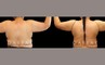 Procedures Depicted:  Liposuction BBR and Arms with J-Plasma