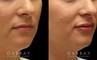 Patient 09 3/4th Right Side View Lip Augmentation Gabbay Plastic Surgery