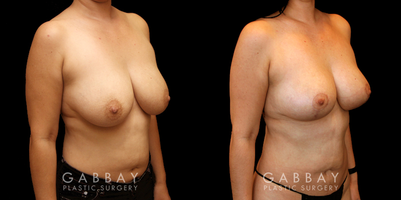Procedures Depicted:  Breast lift and auto aug