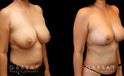 Procedures Depicted:  Breast lift and auto aug