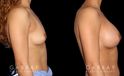 Silicone implant results for female patient in her 30s. Mild increase to volume allowed for balanced results that match her natural body contours.