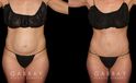 Patient results from tummy tuck. Note before the loose, hanging area at the lower abdomen. Following fat removal and abdominal tightening, the patient achieved a slim, refined silhouette.