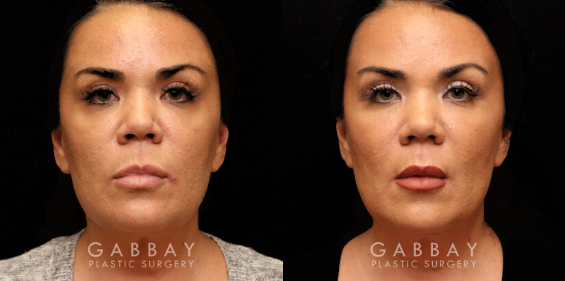 Procedures Depicted:  Buccal Fat Pad Removal