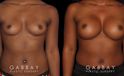 Patient results following recovery of breast augmentation using silicone implants. Note the increase in sense of fullness despite only boosting volume a restrained amount.